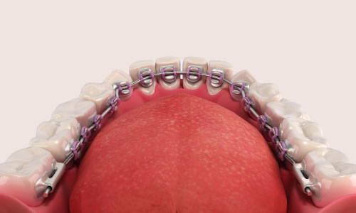 lingual braces