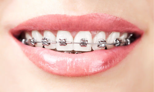 traditional metal braces